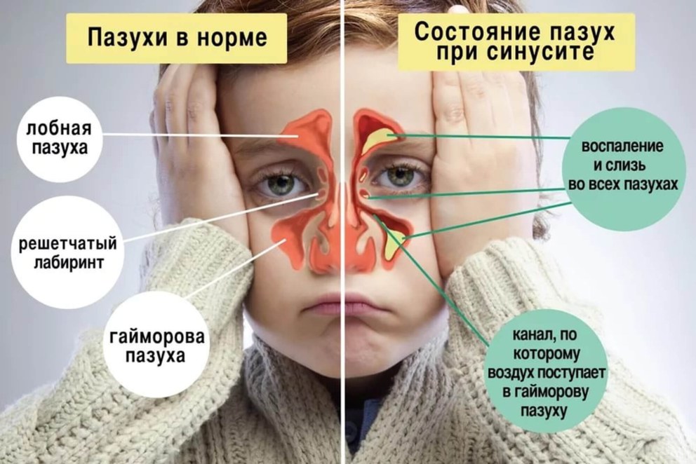Синусит верхнечелюстной пазухи
