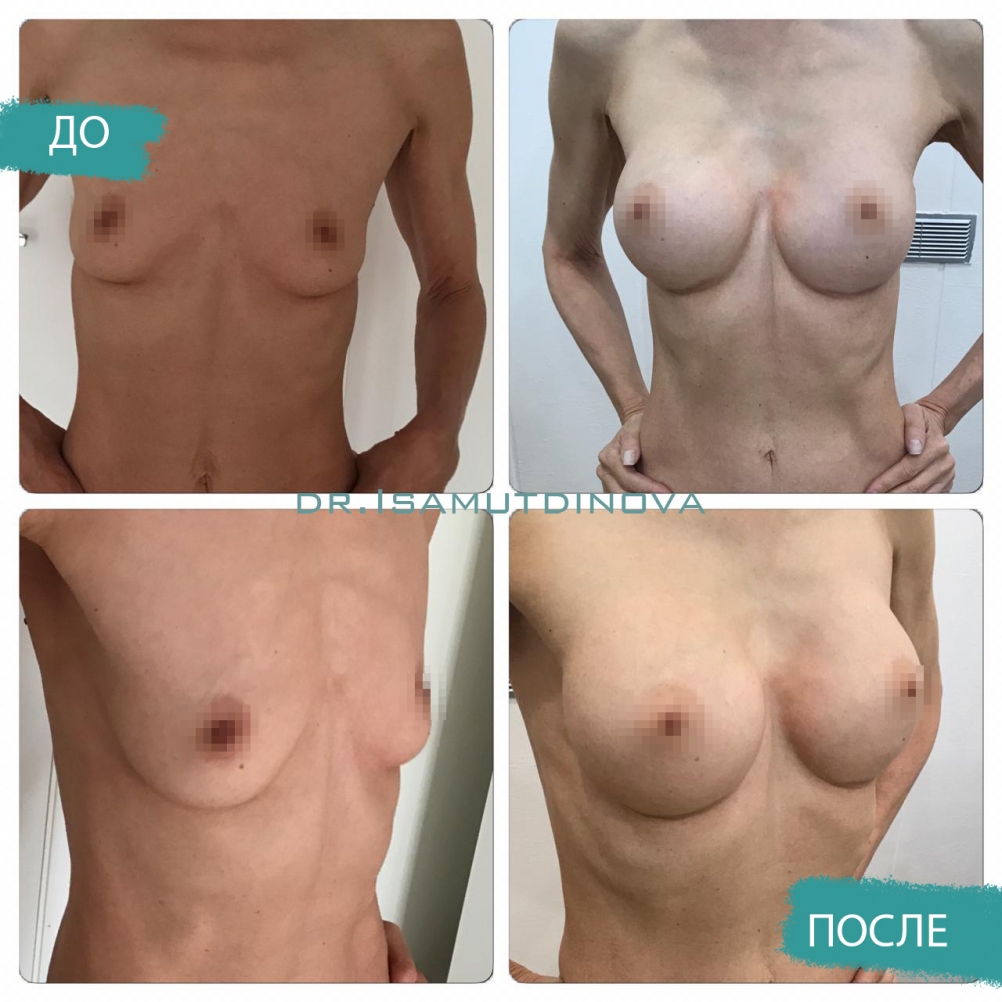 Пластика груди частное